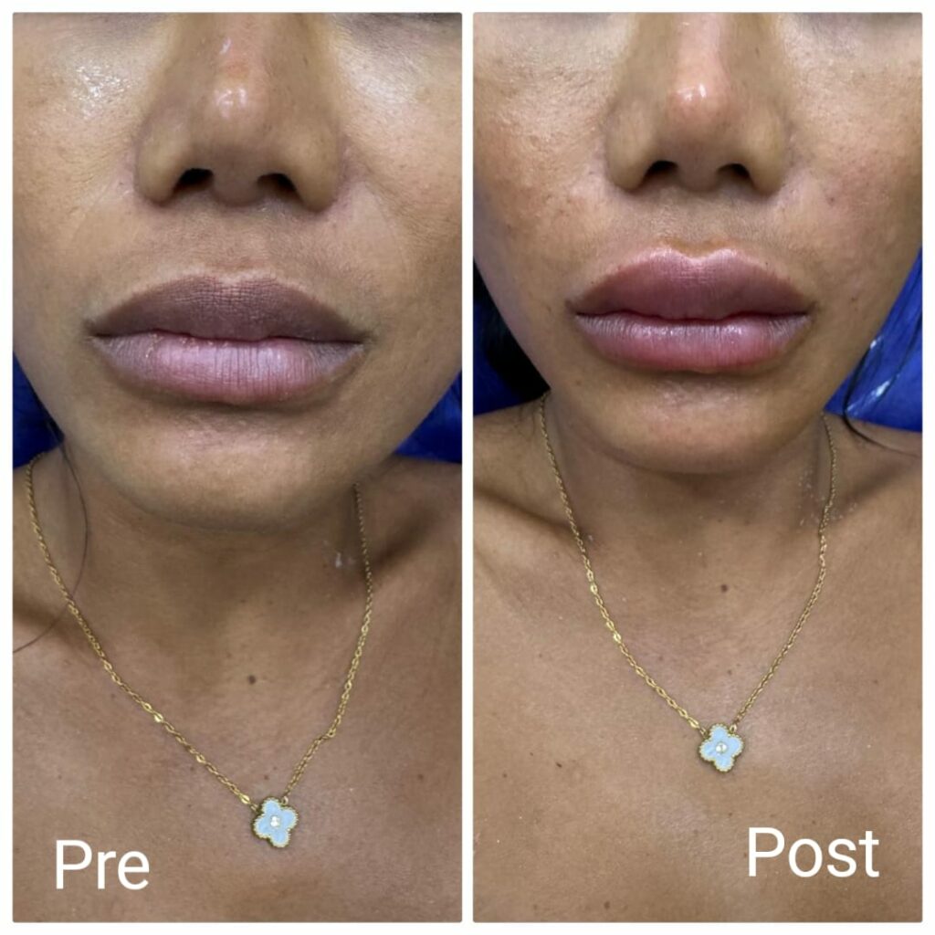 تحديد ذقن و تكبير شفايف بالفيلر